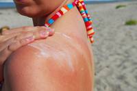 Frau mit Sonnenbrand, Foto:  iStock.com / Joel Carillet